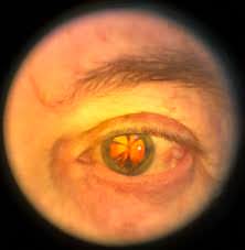 Video Oftalmoscopio NUN de wikioptics incluye adaptador para Smart Phone 4 Video Oftalmoscopio NUN de wikioptics incluye adaptador para Smart Phone -3376